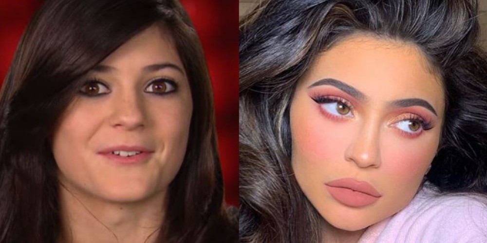 10 famosos que abusaron del bótox en los labios